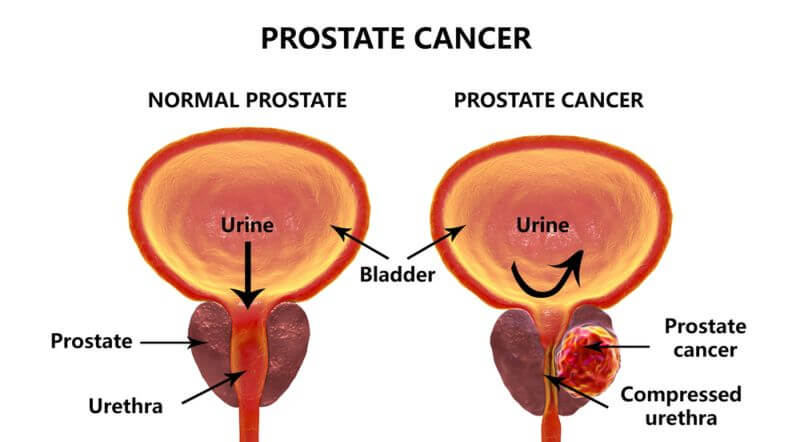 Prostate Cancer: Causes, Symptoms, Diagnosis, and treatment