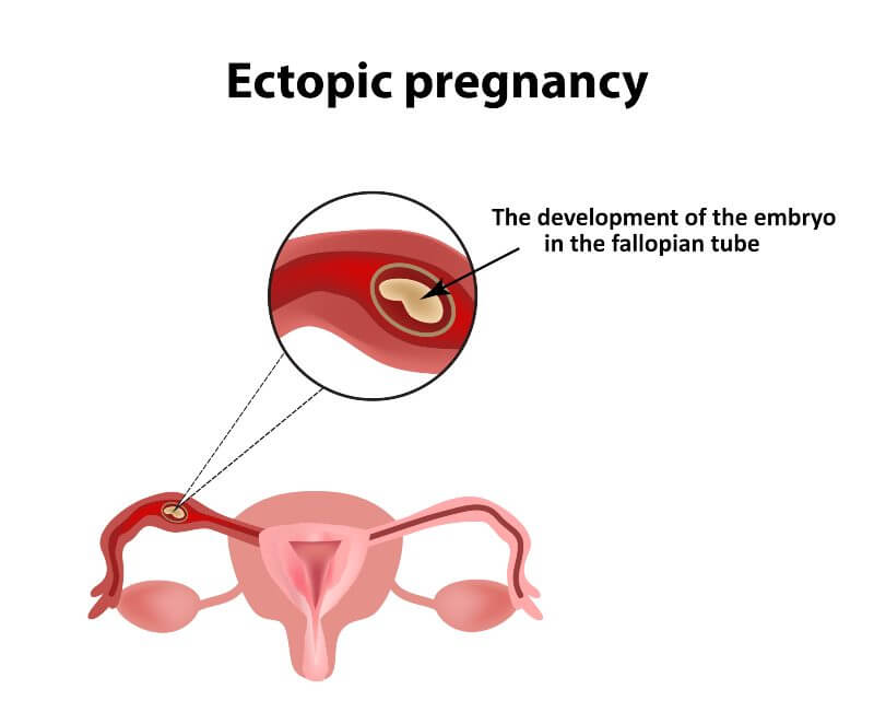 Ectopic pregnancy - Can an ectopic pregnancy be saved?