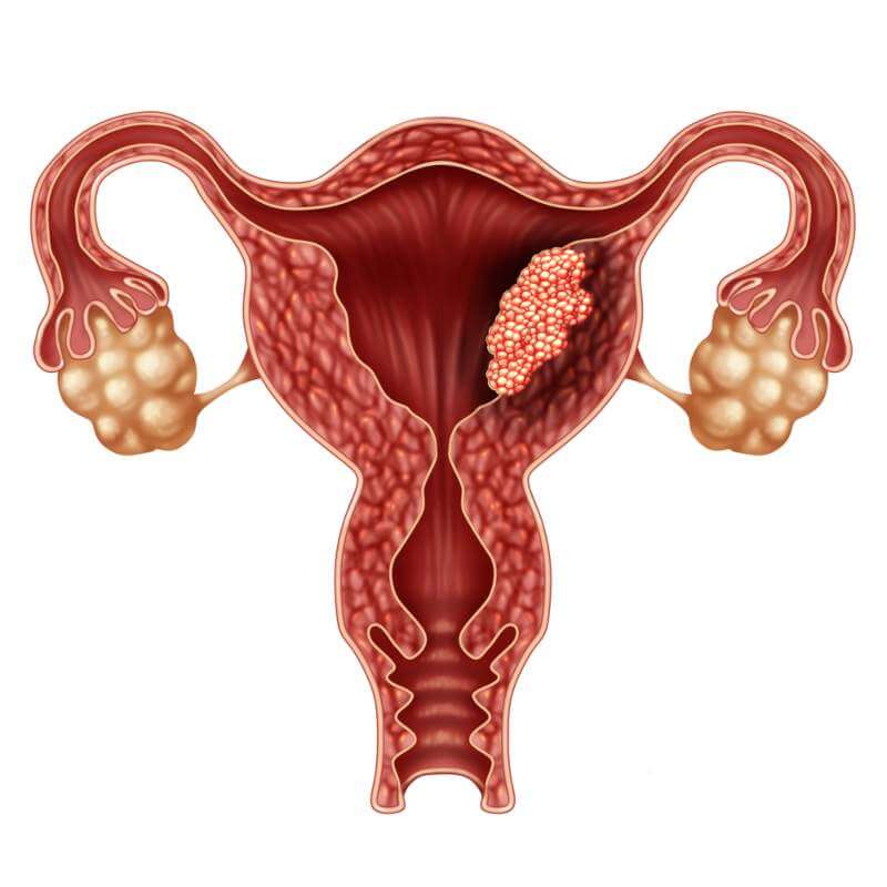 Symptoms of uterus cancer in females
