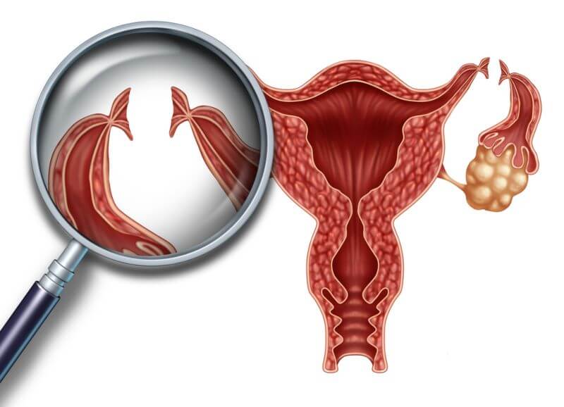 Tubal ligation procedure: side effects, and pregnancy