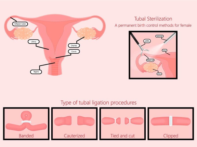 ways of tubes tied surgery