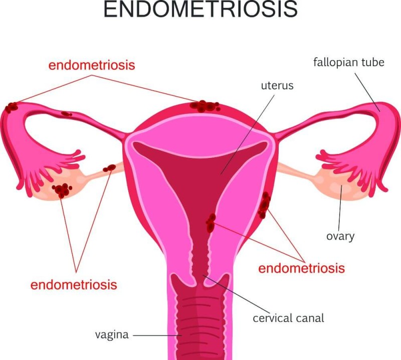 Westpoint Medical Practice - Endometriosis is a common disease where tissue  similar to the lining of the womb grows outside it in other parts of the  body. Symptoms of endometriosis can vary