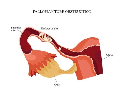 Blocked Fallopian Tubes Symptoms Causes And Treatment