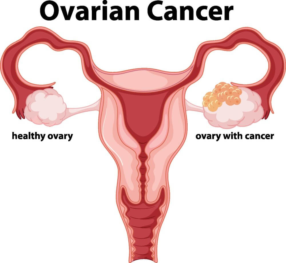 سرطان المبيض – الأعراض والأسباب