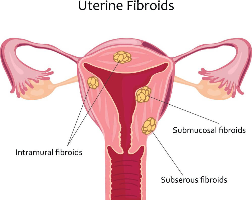 الأورام الليفية في الرحم