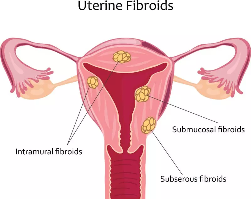 الأورام الليفية في الرحم