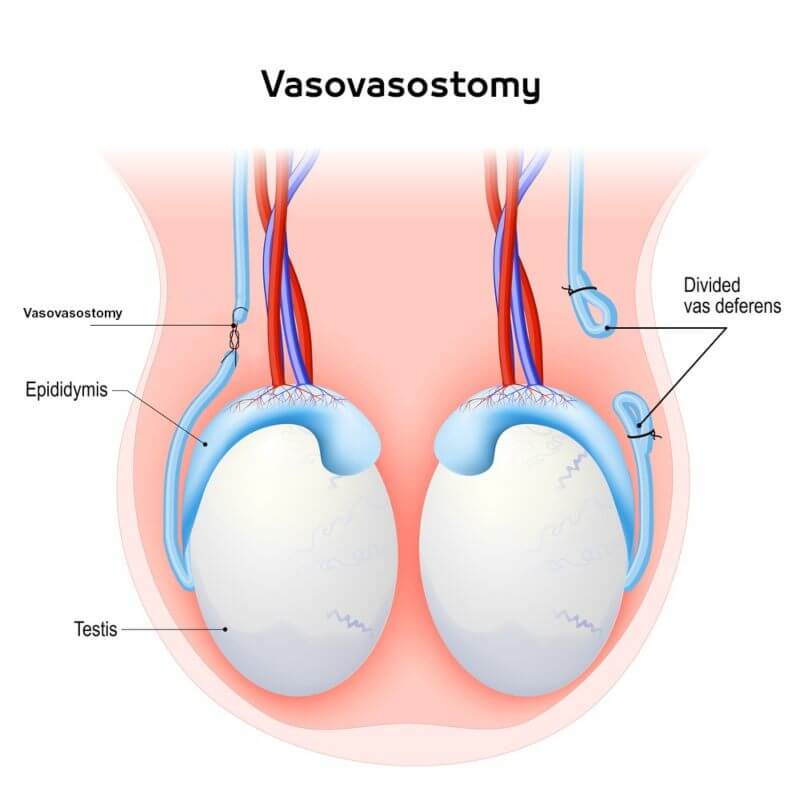 Vasovasostomy