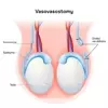 Vasovasostomy