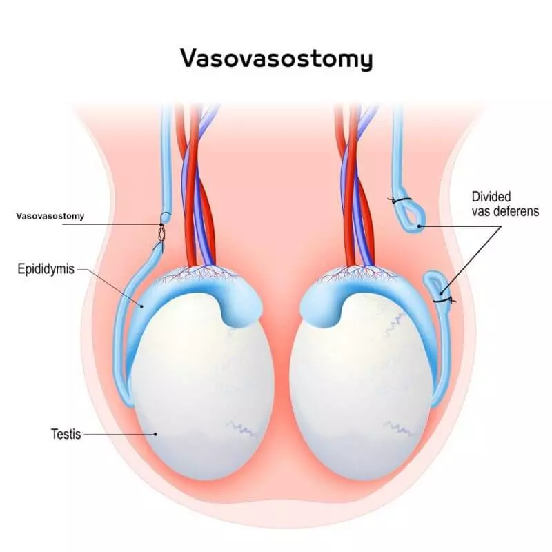 Vasovasostomy