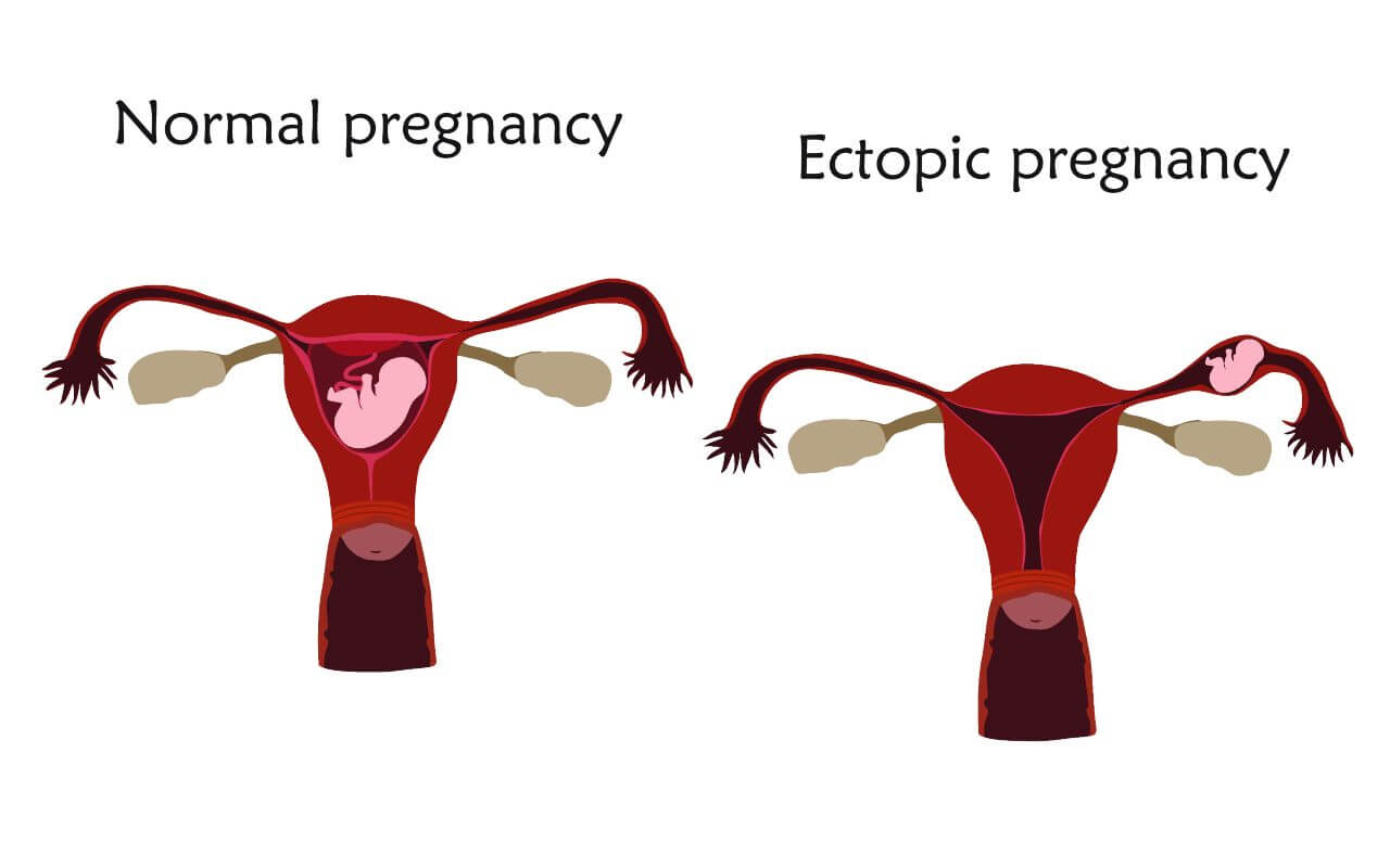 أعراض الحمل خارج الرحم