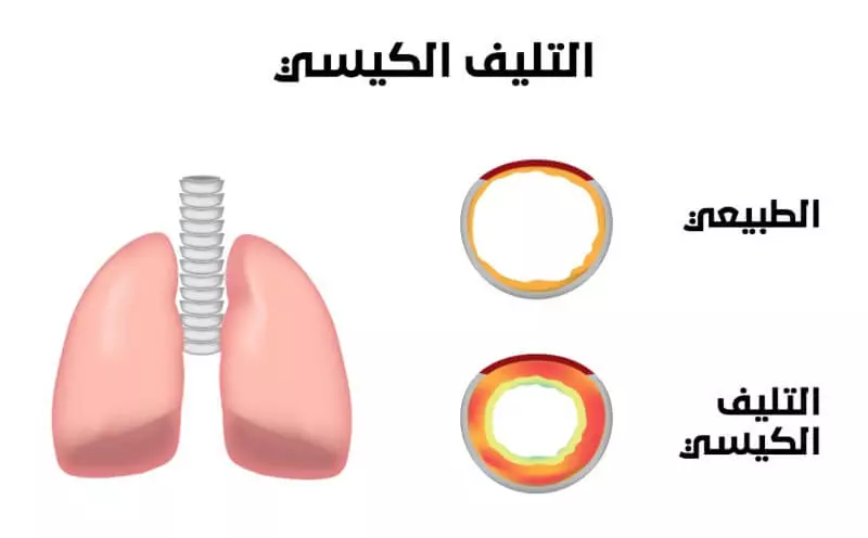 التليف الكيسي : الأعراض والعلاج وكيفية انجاب طفل سليم؟