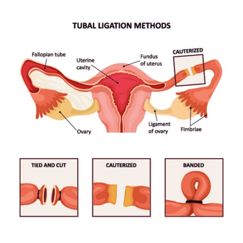 عملية ربط قنوات فالوب لمنع الحمل