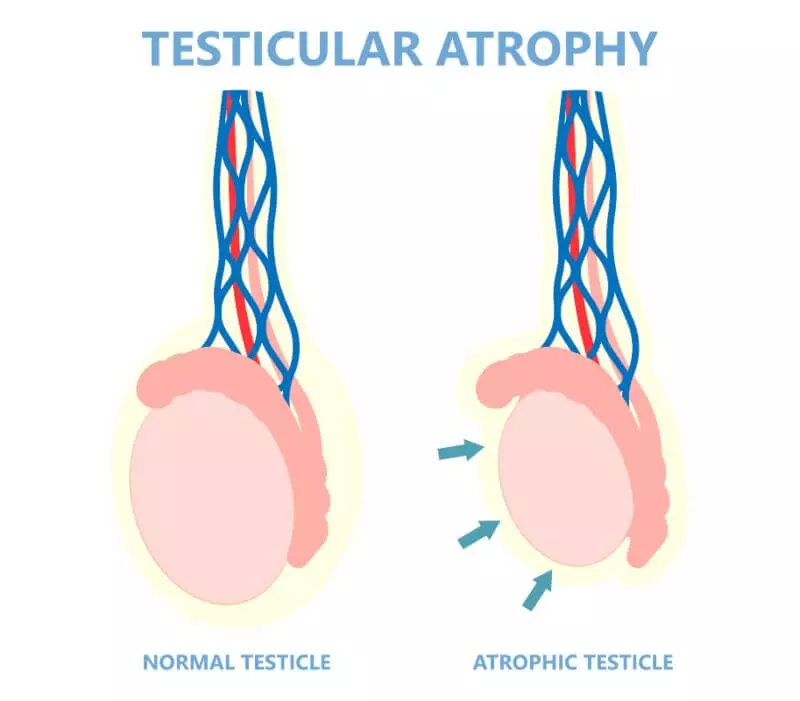 Testicular atrophy