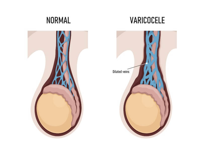 Non-surgical treatment for varicocele-embolization