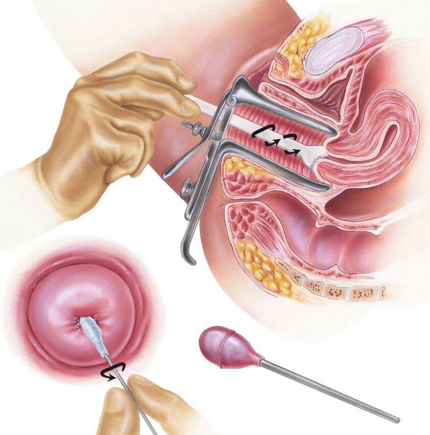 أهمية مسحة عنق الرحم 