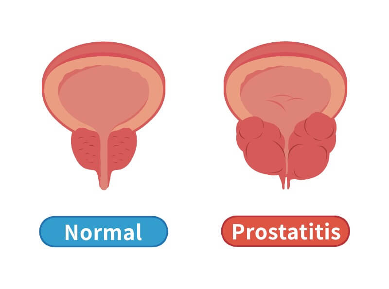 Prostatitis: symptoms, causes, and treatment