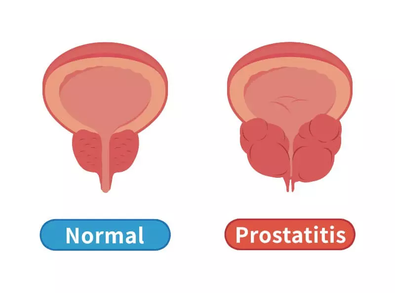 Prostatitis: symptoms, causes, and treatment