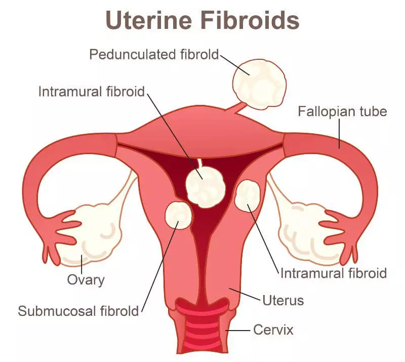 Uterine fibroids