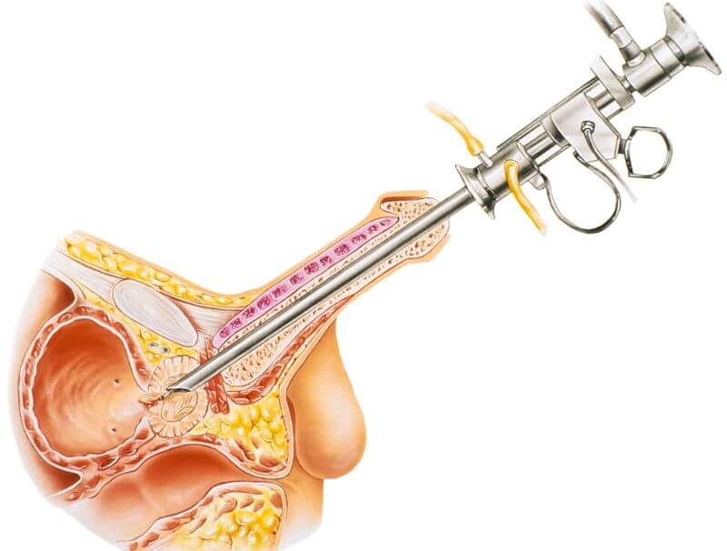 Transurethral Resection Of The Ejaculatory Duct