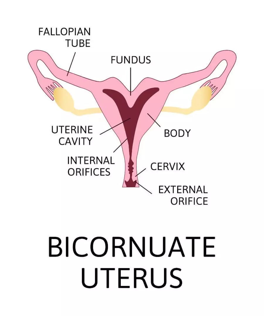 Uterus bicornis (Bicornuate uterus)