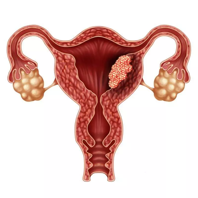 Symptoms of uterus cancer in females