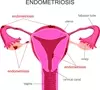 Endometriosis Treatment