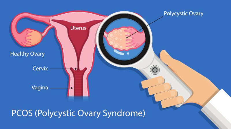 Polycystic ovary syndrome