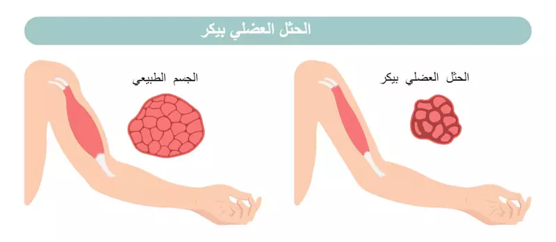  الحثل العضلي بيكر