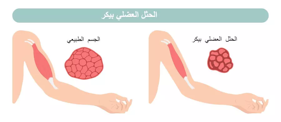  الحثل العضلي بيكر