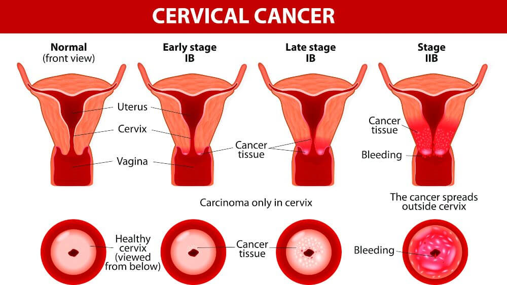 سرطان عنق الرحم- الأسباب والأعراض وطرق العلاج