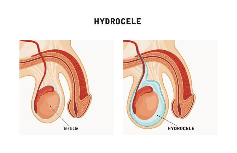 hydrocele surgery before and after