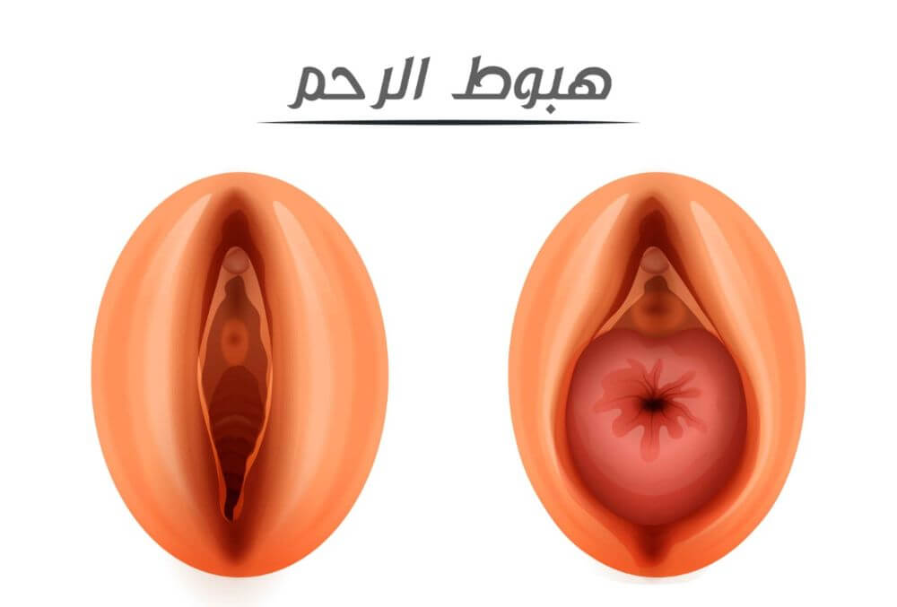 هبوط الرحم - المراحل والعلاج