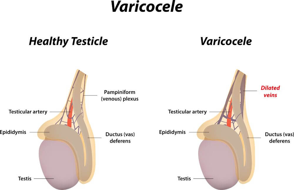 Varicocele treatment without surgery