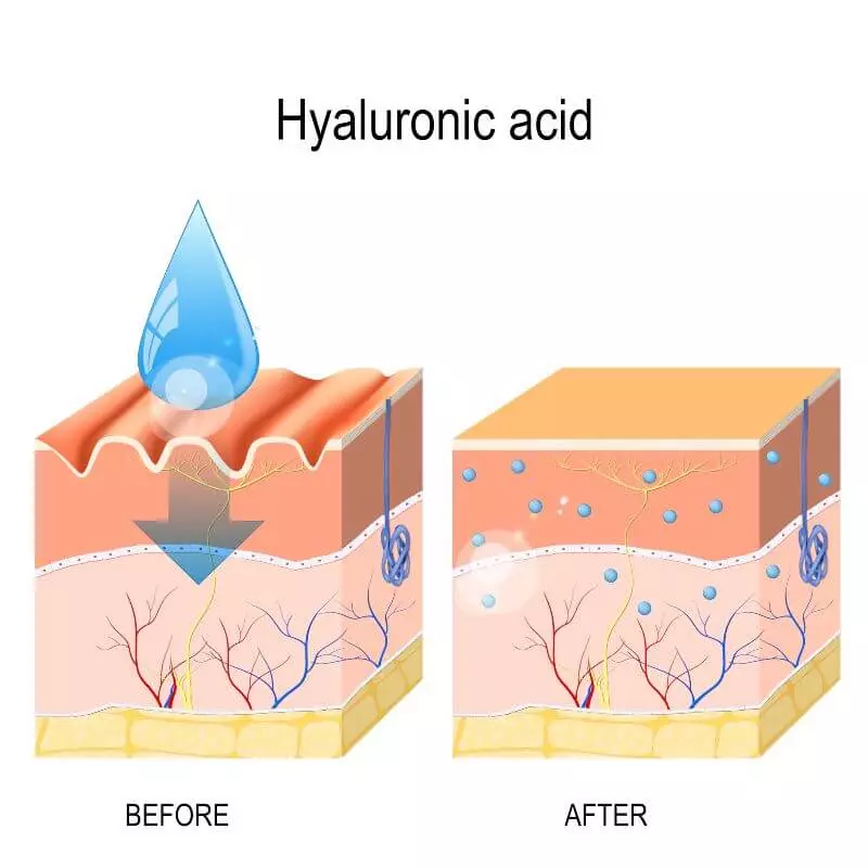 Hyaluronic Acid Injections For Premature Ejaculation