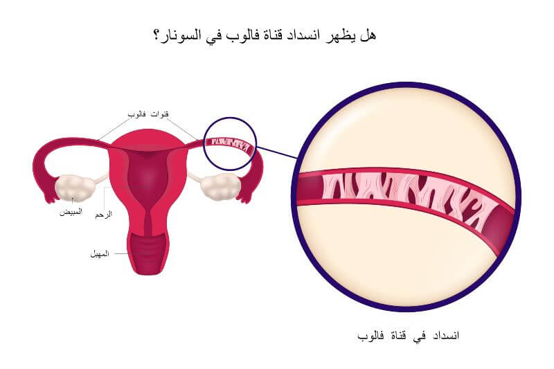 هل يظهر انسداد قناة فالوب في السونار؟