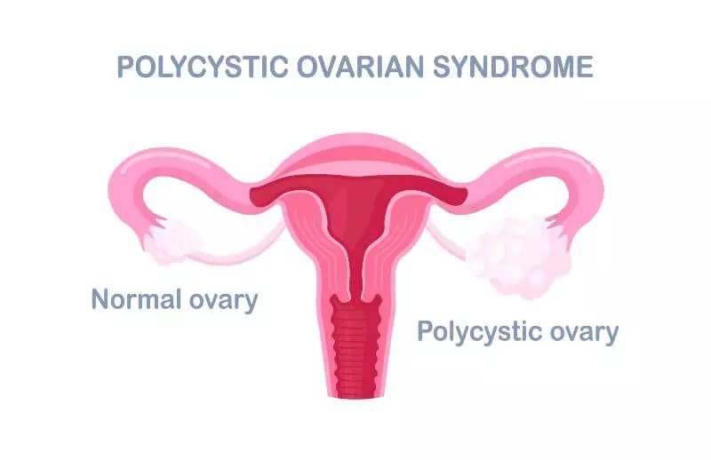 Polycystic Ovary Syndrome Treatment