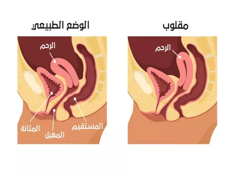 الرحم المقلوب