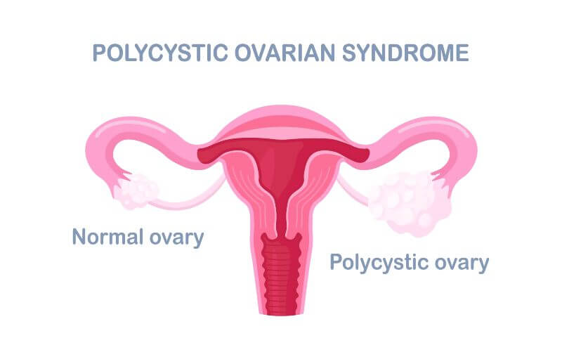 Polycystic Ovary Syndrome Treatment